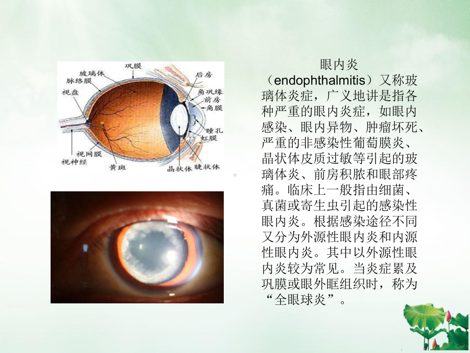 眼内炎患者的疾病课件.pptx_第1页