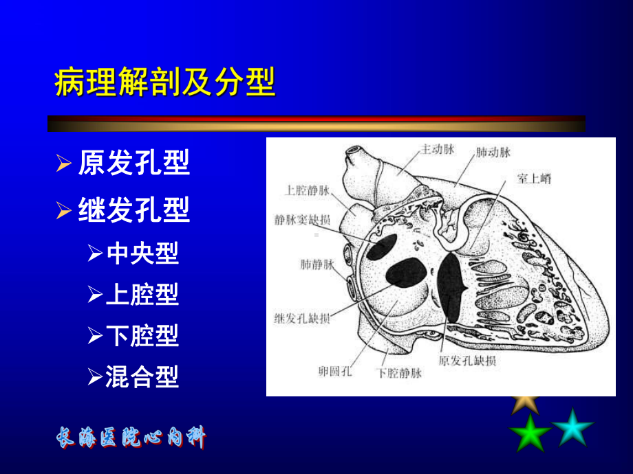 房间隔缺损介入治疗[001]课件.ppt_第2页