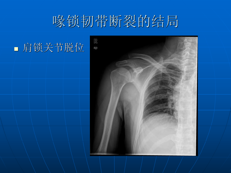 带袢钢板与ETHIBOND缝线双束1课件.ppt_第2页