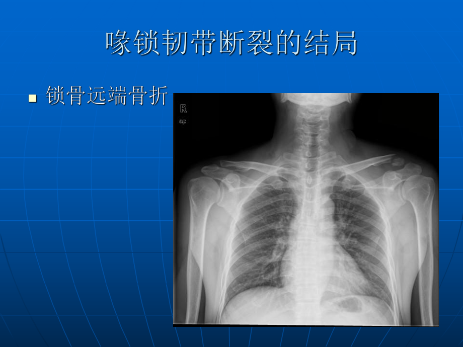 带袢钢板与ETHIBOND缝线双束1课件.ppt_第3页