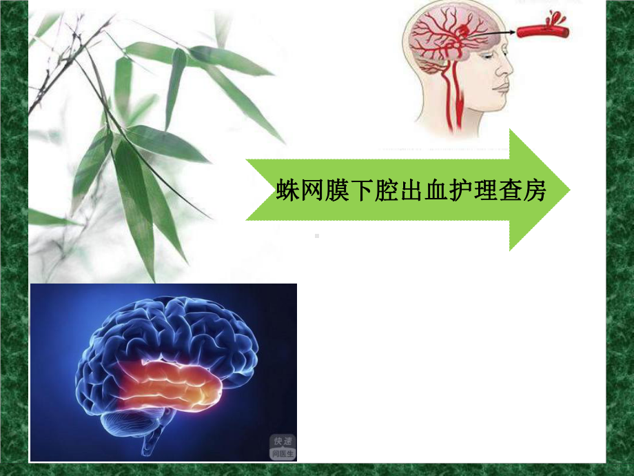 护理查房蛛网膜下腔出血课件.ppt_第1页