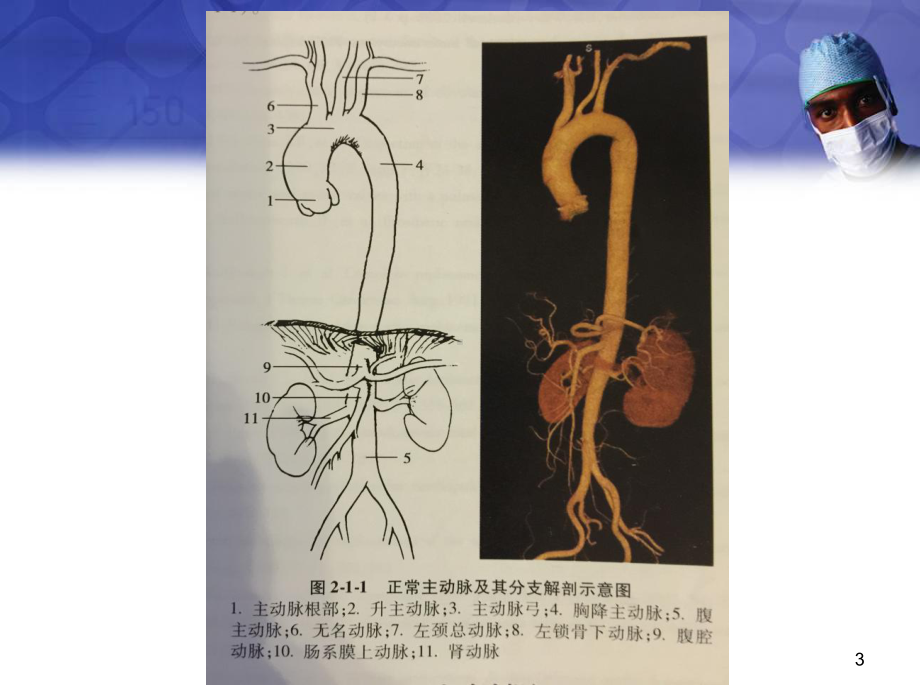 医学课件-主动脉疾病手术简介教学课件.ppt_第3页