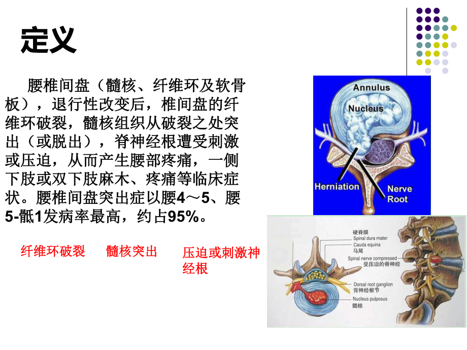 （管理资料）腰椎间盘突出的健康教育汇编课件.ppt_第2页