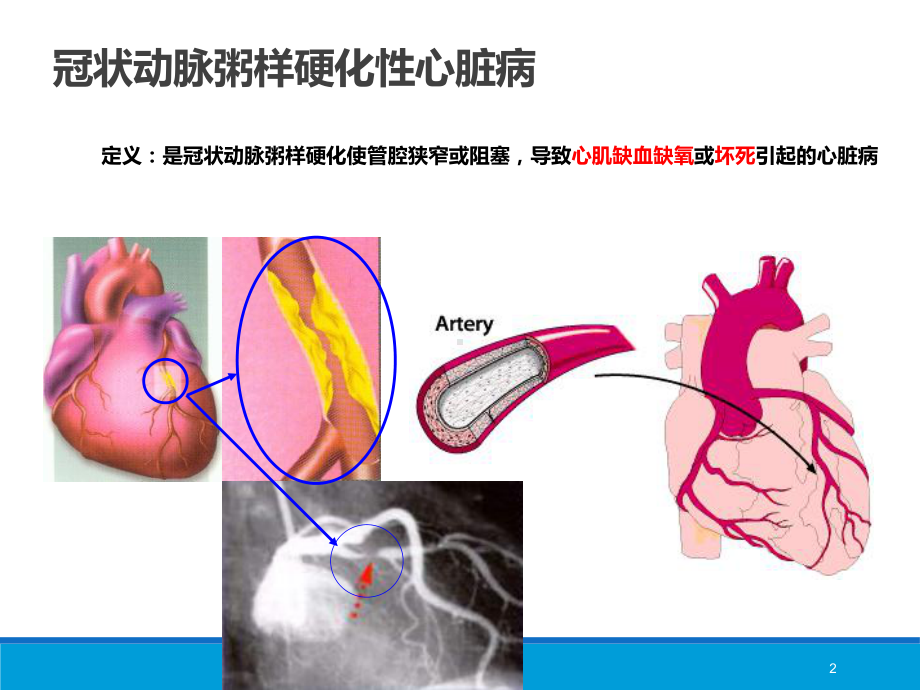 冠脉微循环病变课件.pptx_第3页