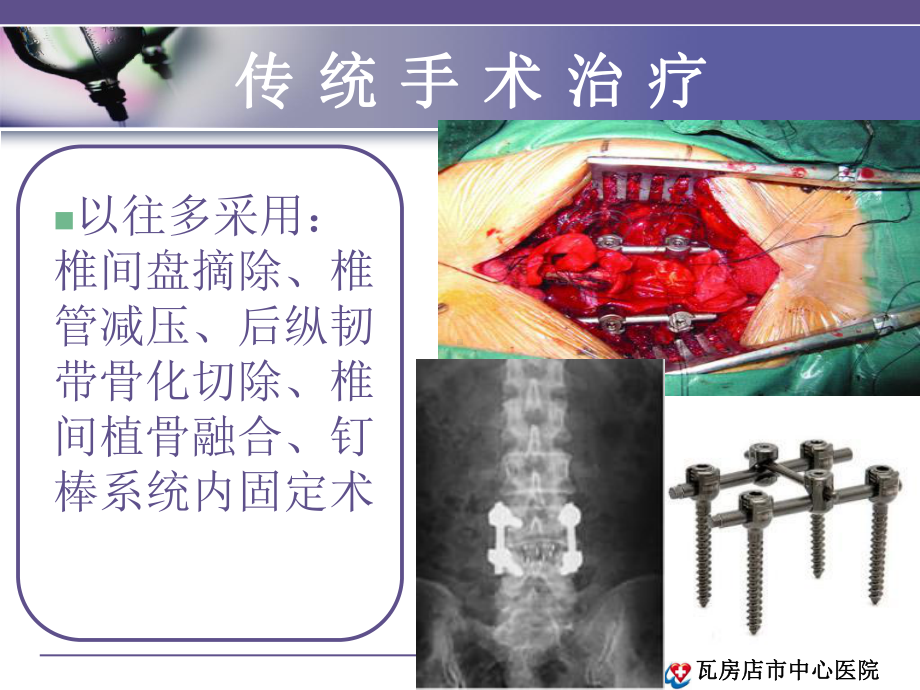 椎间孔镜技术p课件.ppt_第3页