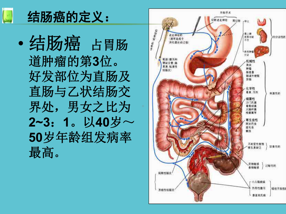 乙状结肠癌护理查房资料课件.ppt_第3页