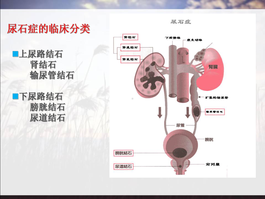 结石医患沟通概要课件.ppt_第3页