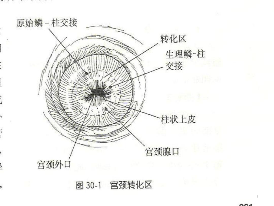 宫颈癌课件资料[文字可编辑].ppt_第3页