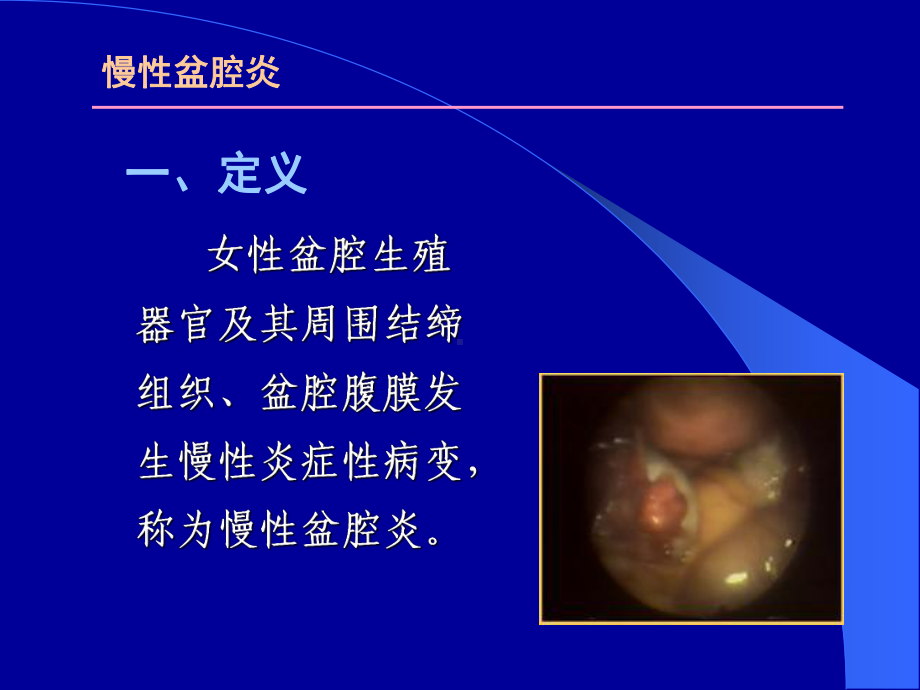 慢性盆腔炎-安徽中医药高等专科学校课件.ppt_第2页