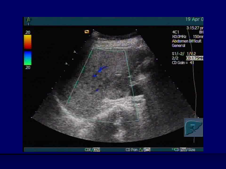 肝脏超声造影分三个时讲课教案课件.ppt_第3页