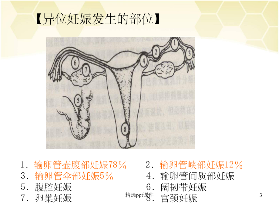 异位妊娠的护理课件1.ppt_第3页