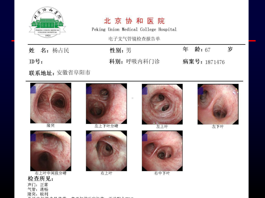 支气管镜和CT定位课件.ppt_第3页