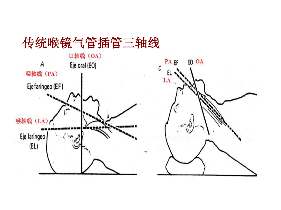 氧瞬得-喉镜教学课件.ppt_第2页