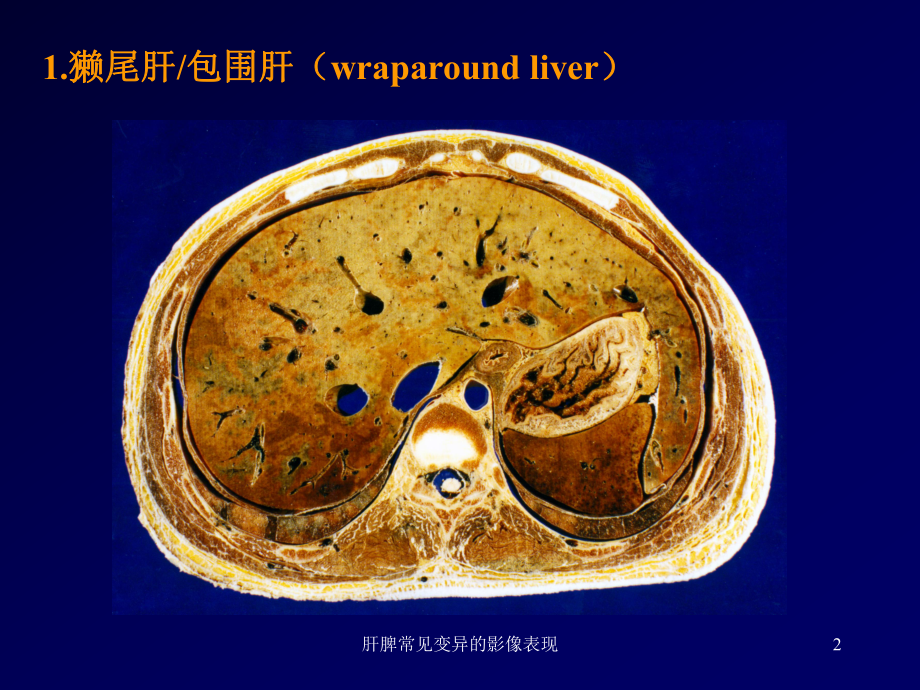 肝脾常见变异的影像表现课件.ppt_第2页