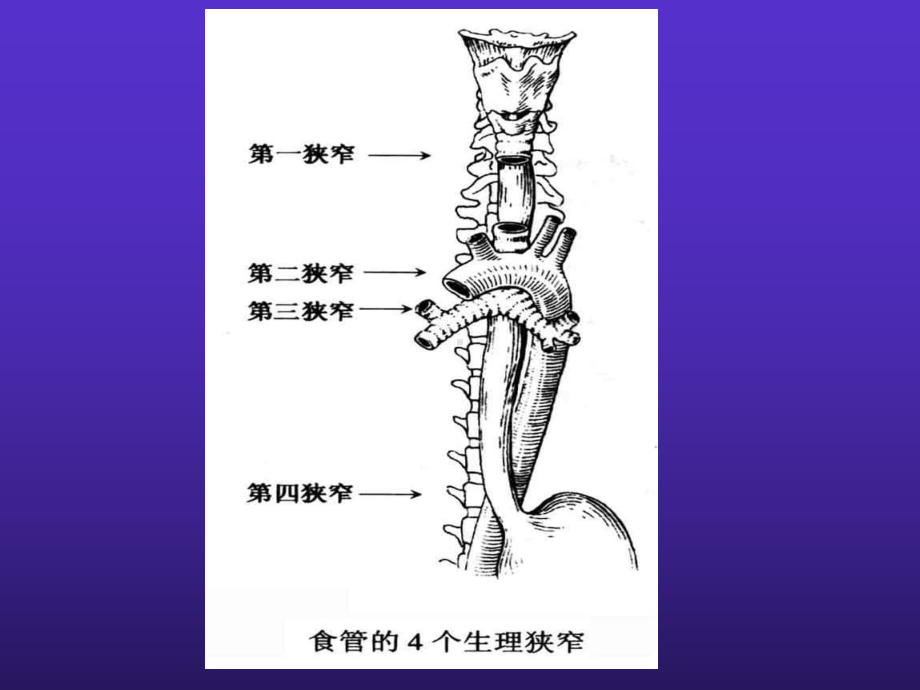 七年制医学课件耳鼻喉7食管异物.ppt_第3页