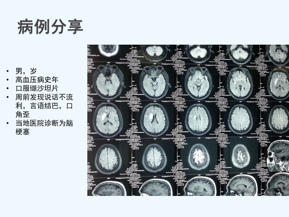 神经外科患者围手术期出血及凝血功能障碍处理课件.pptx_第2页