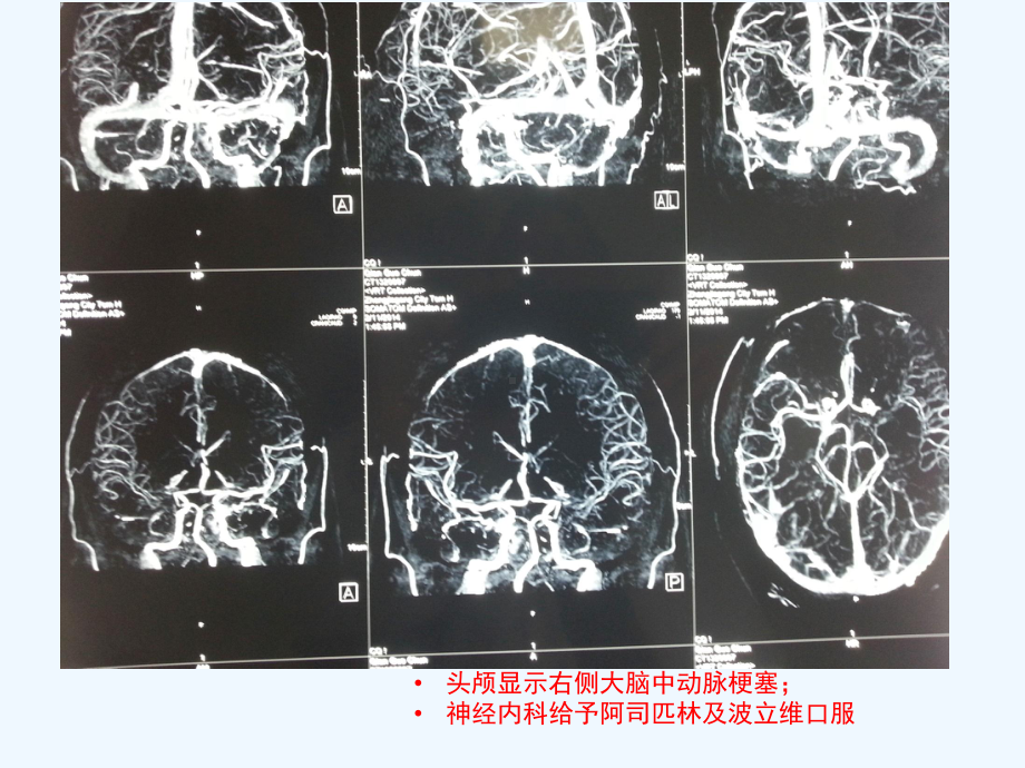 神经外科患者围手术期出血及凝血功能障碍处理课件.pptx_第3页