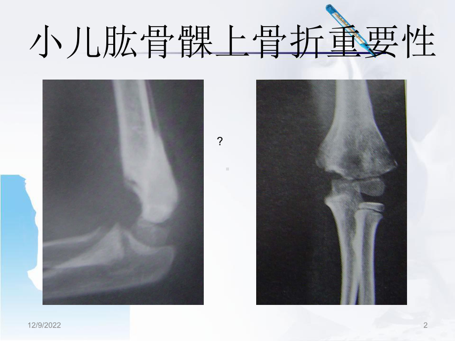 小儿肱骨髁上骨折医学课件.ppt_第2页