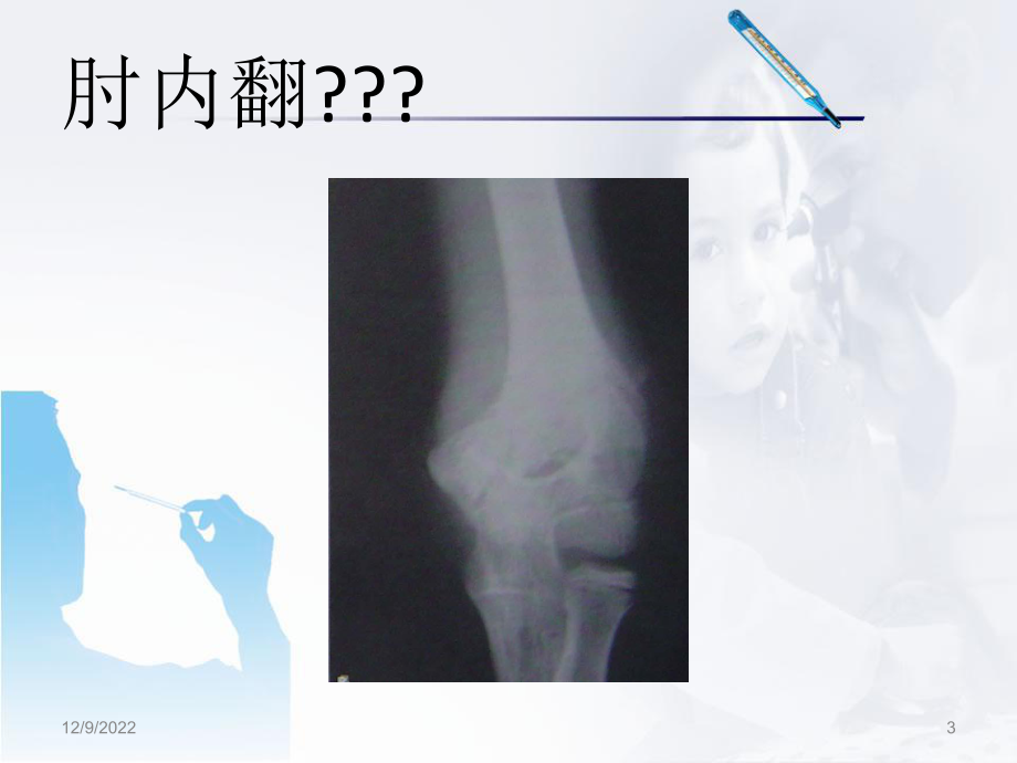 小儿肱骨髁上骨折医学课件.ppt_第3页