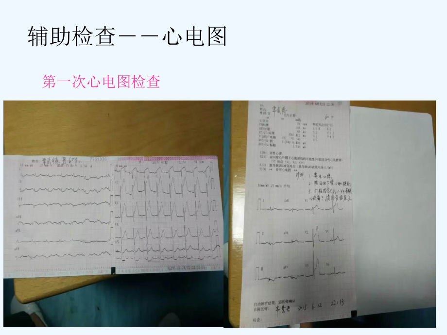 急性心肌梗塞的护理查房课件.ppt_第3页