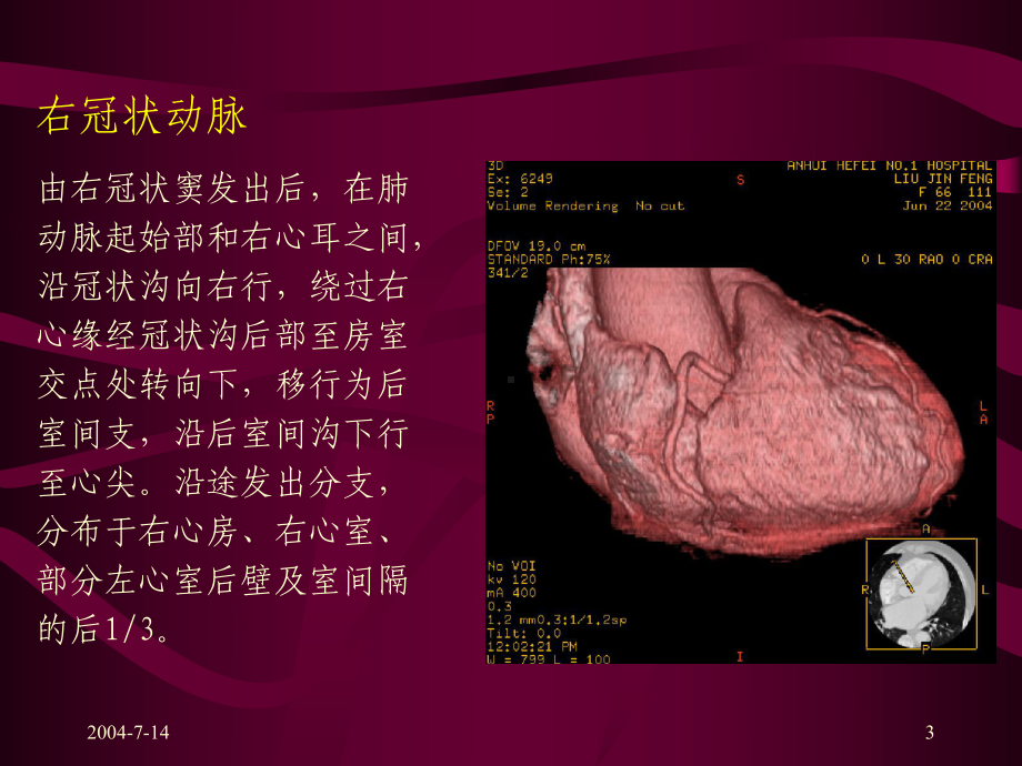 冠状动脉解剖与CT表现课件.ppt_第3页