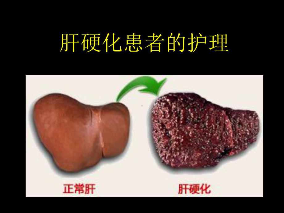 第八节肝硬化病人的护理课件.ppt_第1页