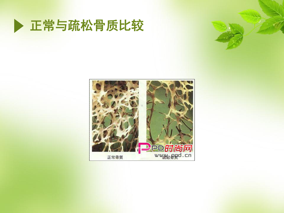 老年性骨质疏松症治疗与预防护理课件.ppt_第3页