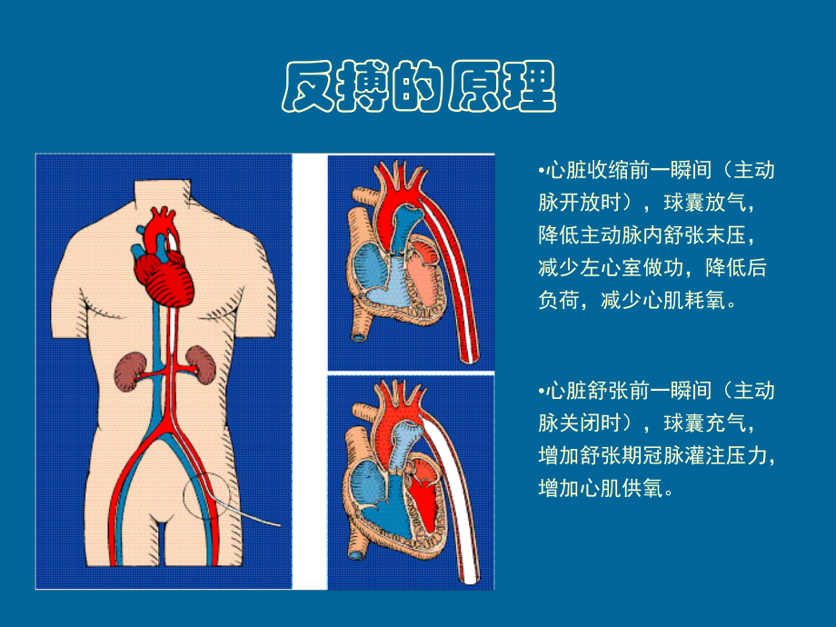 主动脉内球囊反搏泵培训课件.ppt_第3页