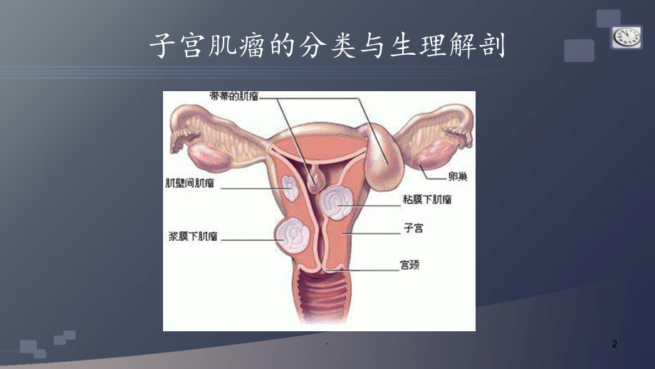 子宫肌瘤的护理查房课件.pptx_第2页