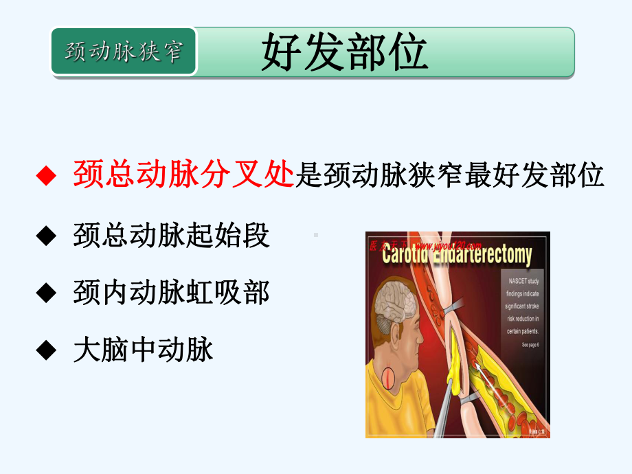 颈动脉狭窄的治疗与护理-第四军医大学唐都医院神经外科课件.ppt_第3页