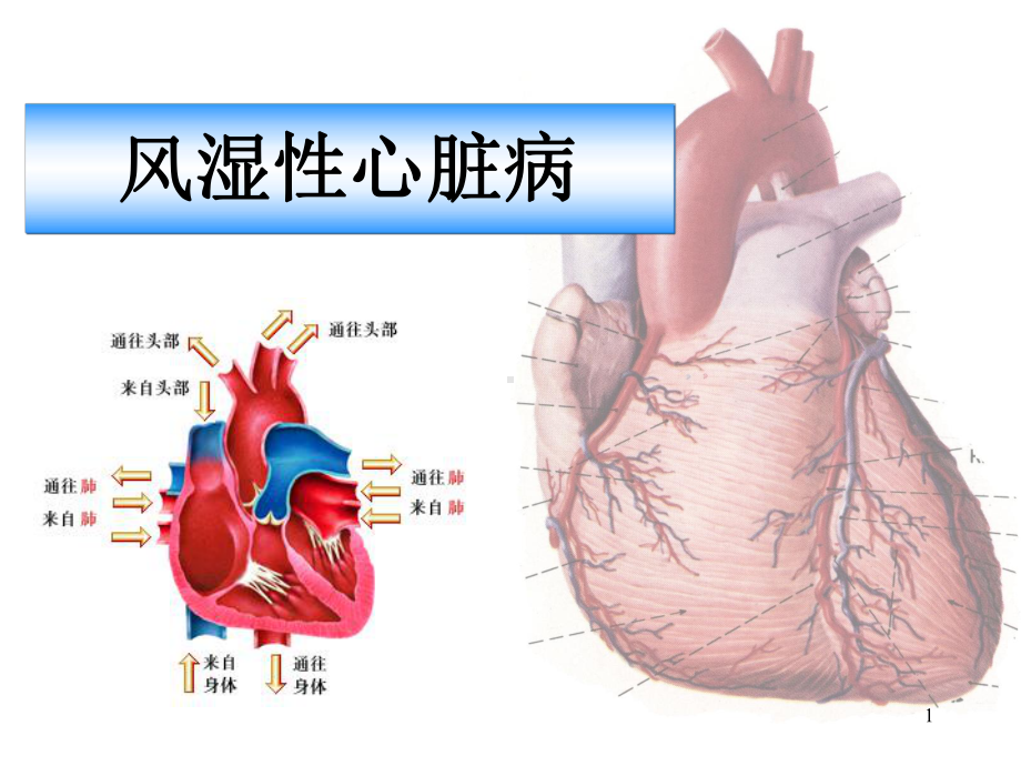 风湿性心脏病影像诊断与鉴别学习课件.ppt_第1页