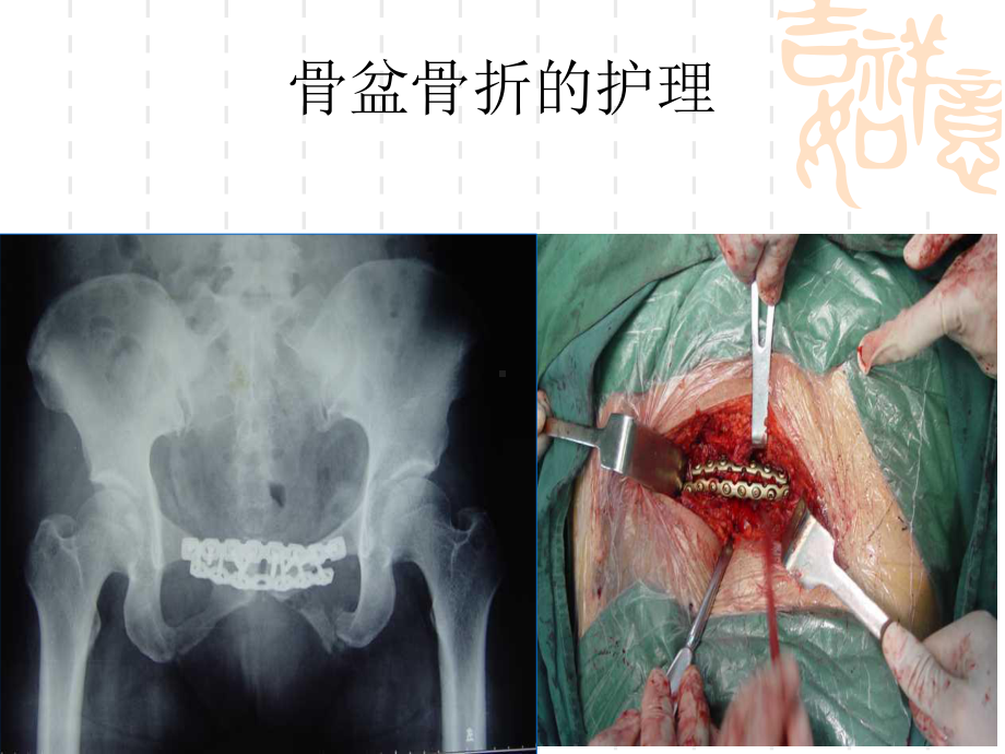 骨盆骨折的护理课件.pptx_第1页