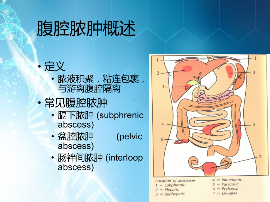 腹腔脓肿课件.pptx_第2页