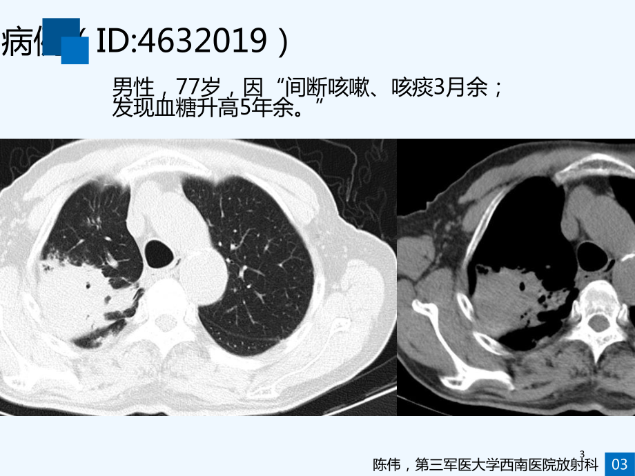 肺部真菌与结核诊断与鉴别诊断课件.ppt_第3页