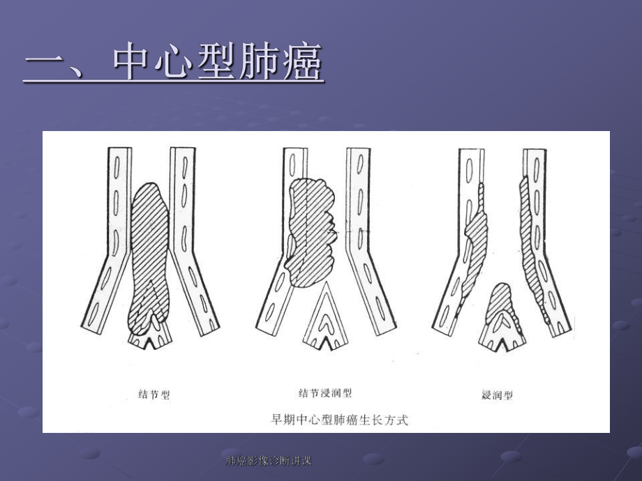 肺癌影像诊断讲课课件.ppt_第3页