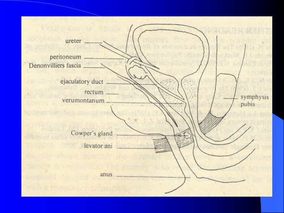 良性前列腺增生Benign-Prostatic-Hyperplasia课件.ppt_第2页