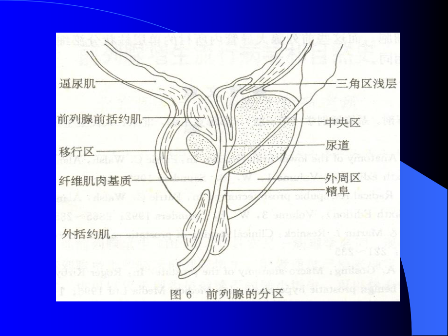 良性前列腺增生Benign-Prostatic-Hyperplasia课件.ppt_第3页