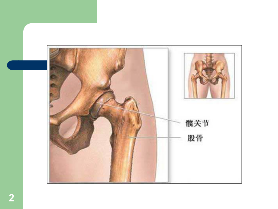 髋关节置换术后的的护理课件.ppt_第2页