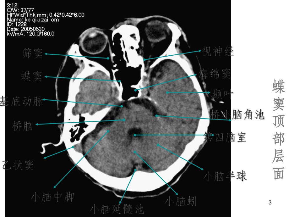 颅脑常见疾病CT诊断课件.ppt_第3页