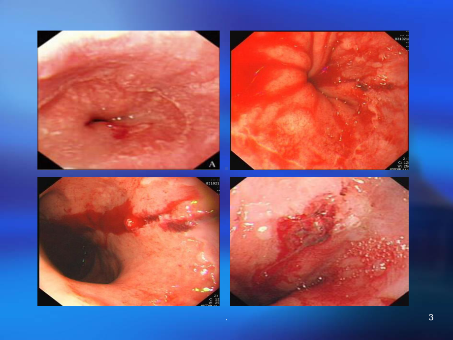 贲门粘膜撕裂教学课件.pptx_第3页