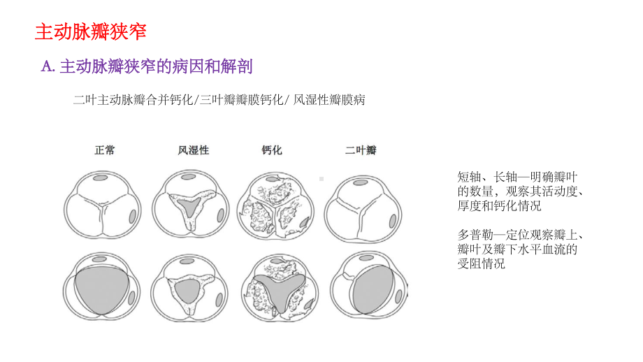 超声心动图评估瓣膜狭窄的建议课件.ppt_第3页