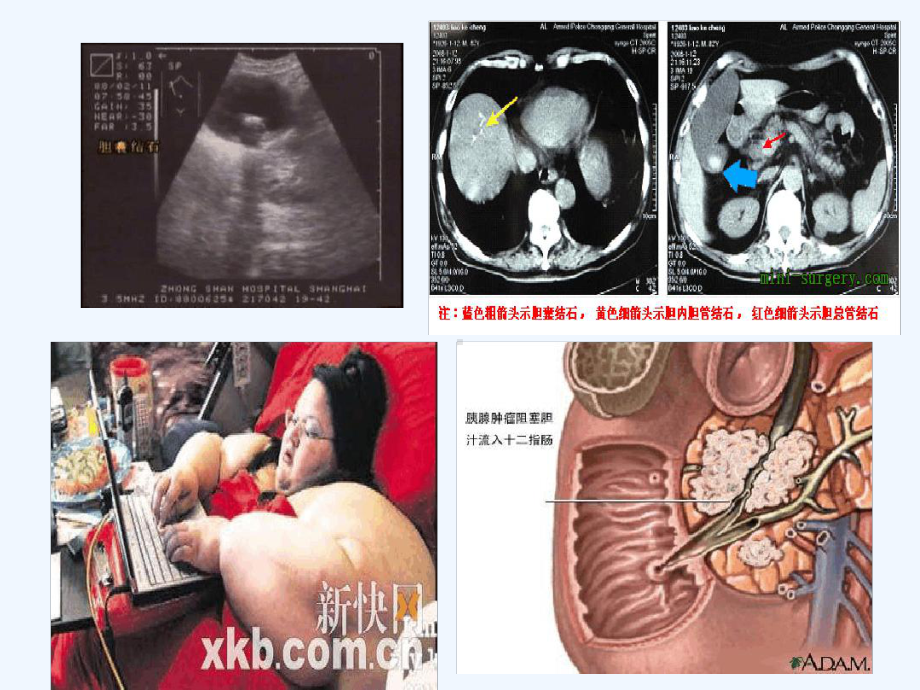 胆道感染的抗菌治疗更新版课件.ppt_第3页