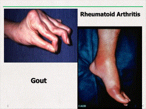 风湿性疾病教学课件下载.pptx