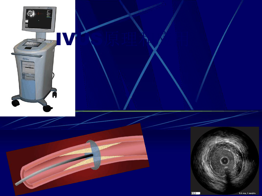 血管内超声IVUS原理和应用课件.ppt_第1页