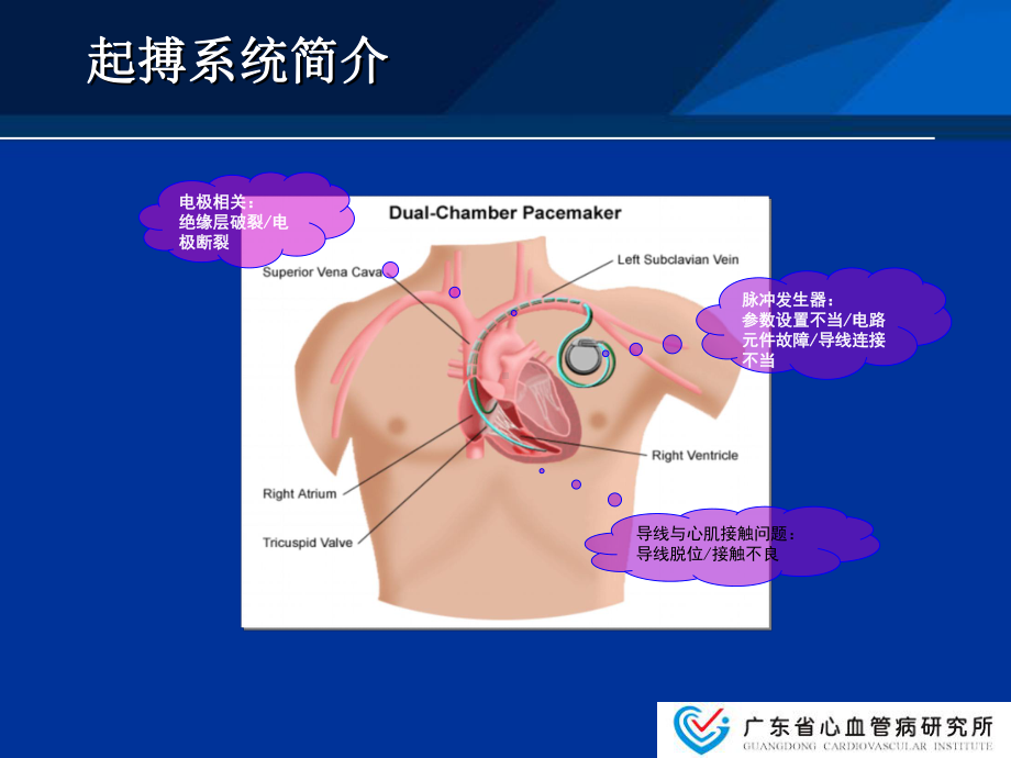 起搏器故障心电图分析课件.ppt_第2页