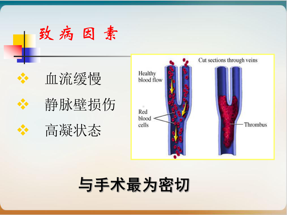 骨科大手术DVT预防课件.pptx_第2页