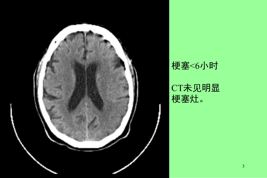 脑栓塞护理查房优质课件.ppt_第3页