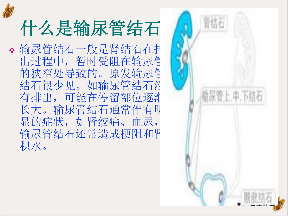 输尿管结石讲课下载课件.pptx_第2页