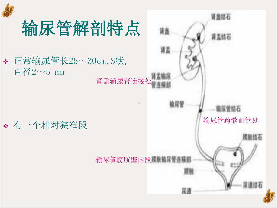 输尿管结石讲课下载课件.pptx_第3页