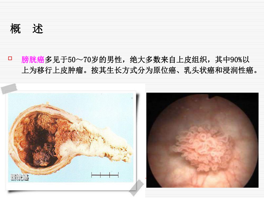 膀胱癌护理查房医学课件.ppt_第2页